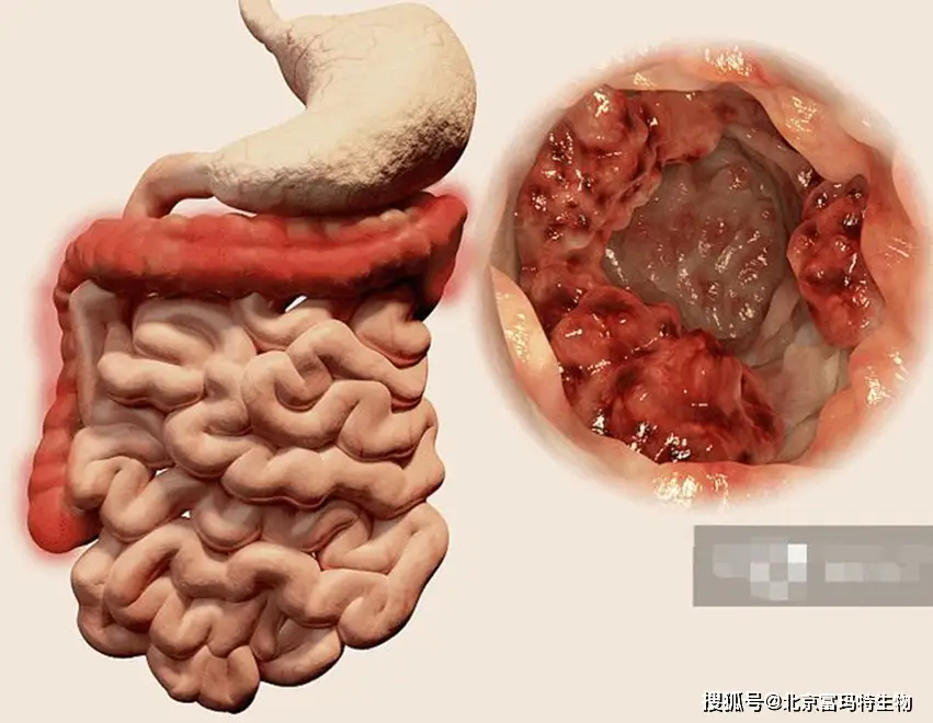 克罗恩病好发部位_罗克罗恩病_罗克恩病严重吗