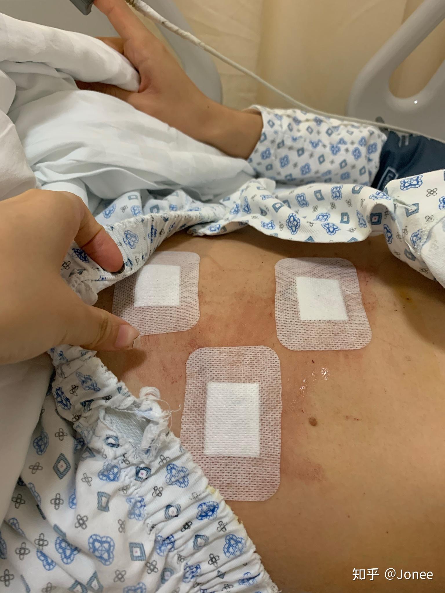 急性阑尾炎术后并发症护理-急性阑尾炎手术后的护理要点，你必须知道