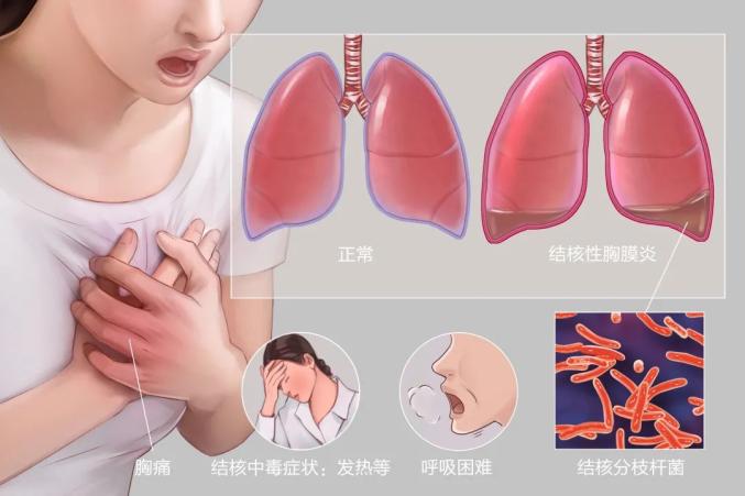 三型肺结核的症状-三型肺结核症状揭秘：咳嗽、发热、消瘦、乏力，如何应对？