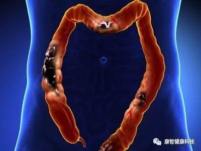 鲜血大便拉出血块_大便拉出鲜血_鲜血大便