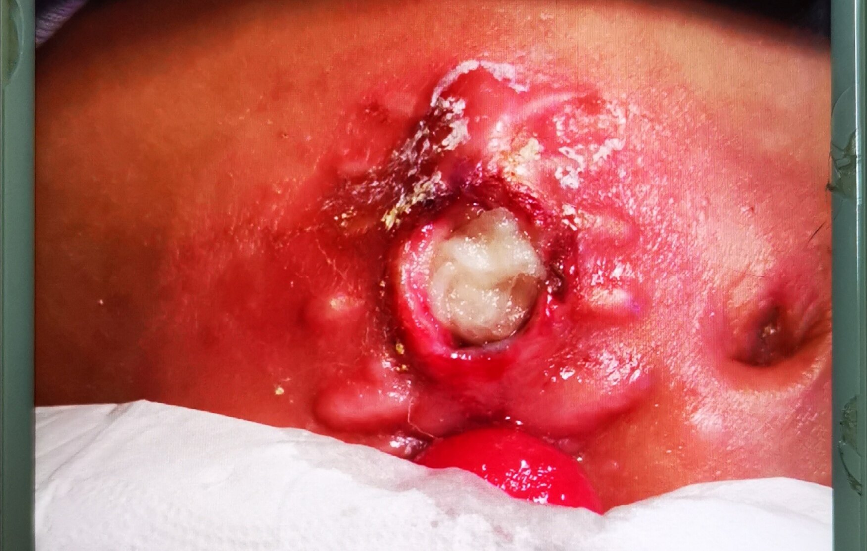 克罗恩可以买保险吗_得了克罗恩能买保险吗_保险克罗恩病是重大疾病吗