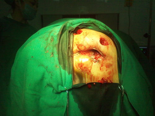 肛瘘术后坐浴一次多久_多长手术坐浴肛瘘时间后不疼_肛瘘手术后多长时间坐浴