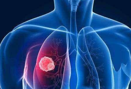 空洞型肺结核严重后果是什么_空洞型肺结核严重吗_空洞型肺结核严重程度