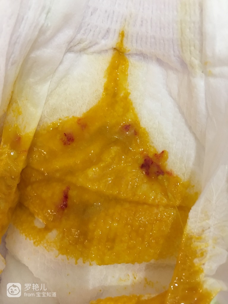 拉大便拉出鲜血_大便拉出鲜血的原因_鲜血原因大便拉出血块