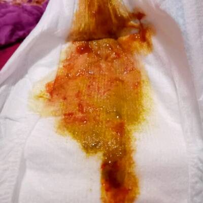 鲜血原因大便拉出血块_拉大便拉出鲜血_大便拉出鲜血的原因