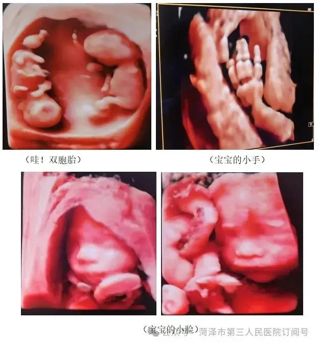 哪能做四维检查_能四维检查做四维吗_四维检查做多久
