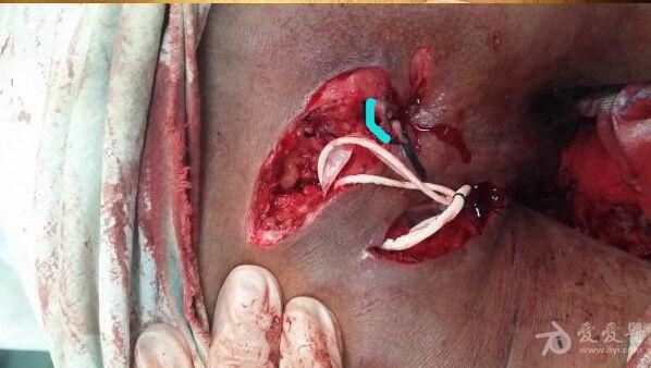 肛瘘手术多久换药一次_多长手术换药肛瘘时间长一点_肛瘘手术换药多长时间