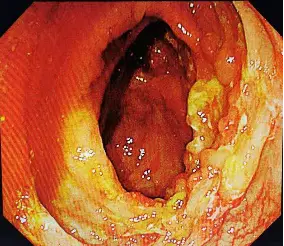 罗克恩病能治好吗_克罗恩病治疗_罗克罗恩病