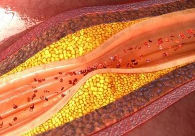 得了冠心病高血压能活几年_高血压冠心病能除根吗_血压高冠心病