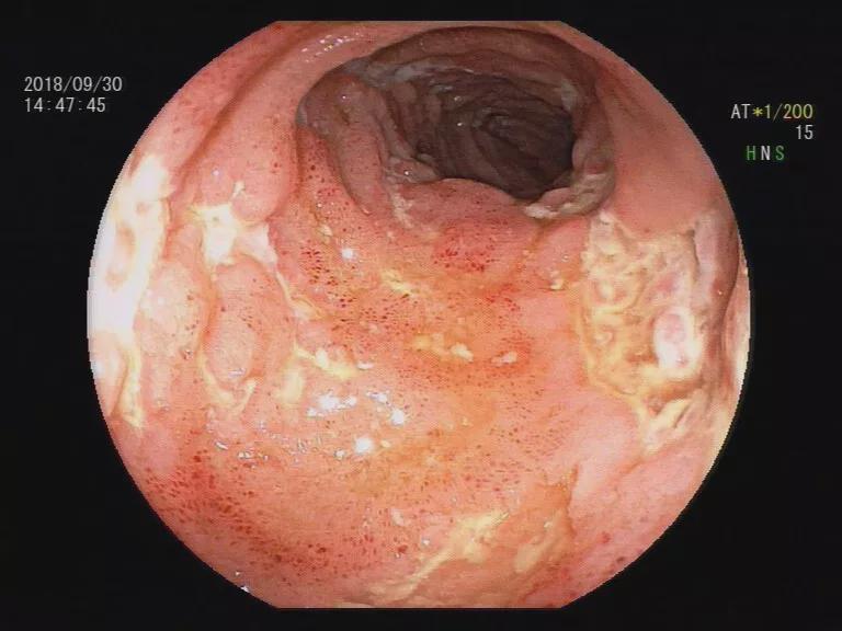 克罗恩医保用药_克罗恩进医保_克罗恩类克能医保吗