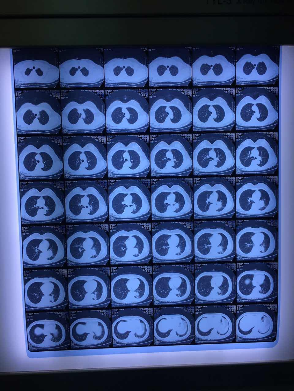 肺空洞上有炎症化脓_肺上有空洞_肺空洞有先天性的吗