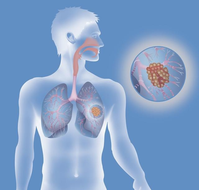 肺空洞上有炎症化脓_肺空洞有先天性的吗_肺上有空洞