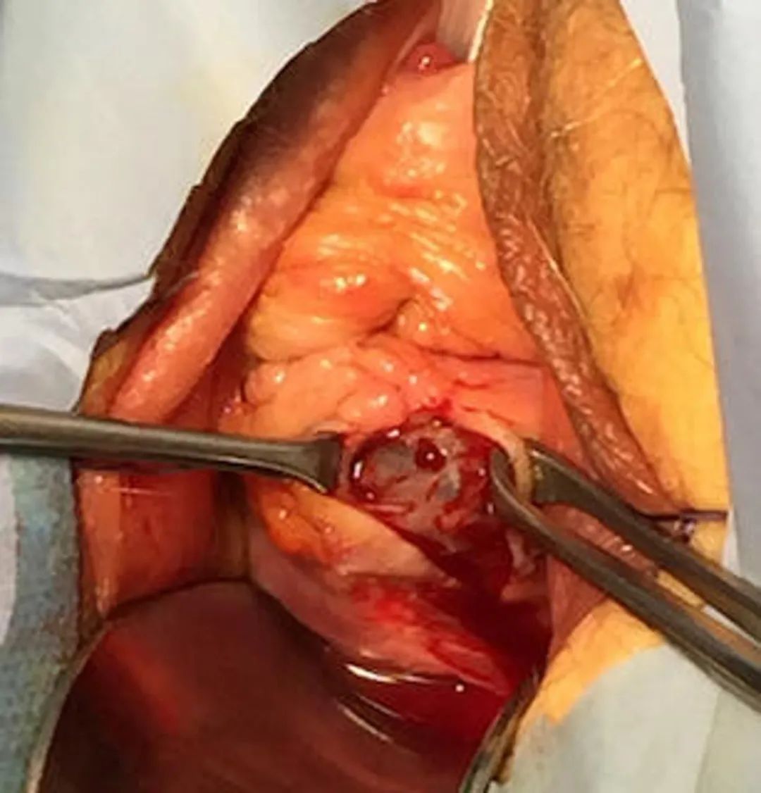 肛门失禁的案例_肛门失禁定义_肛门失禁患者