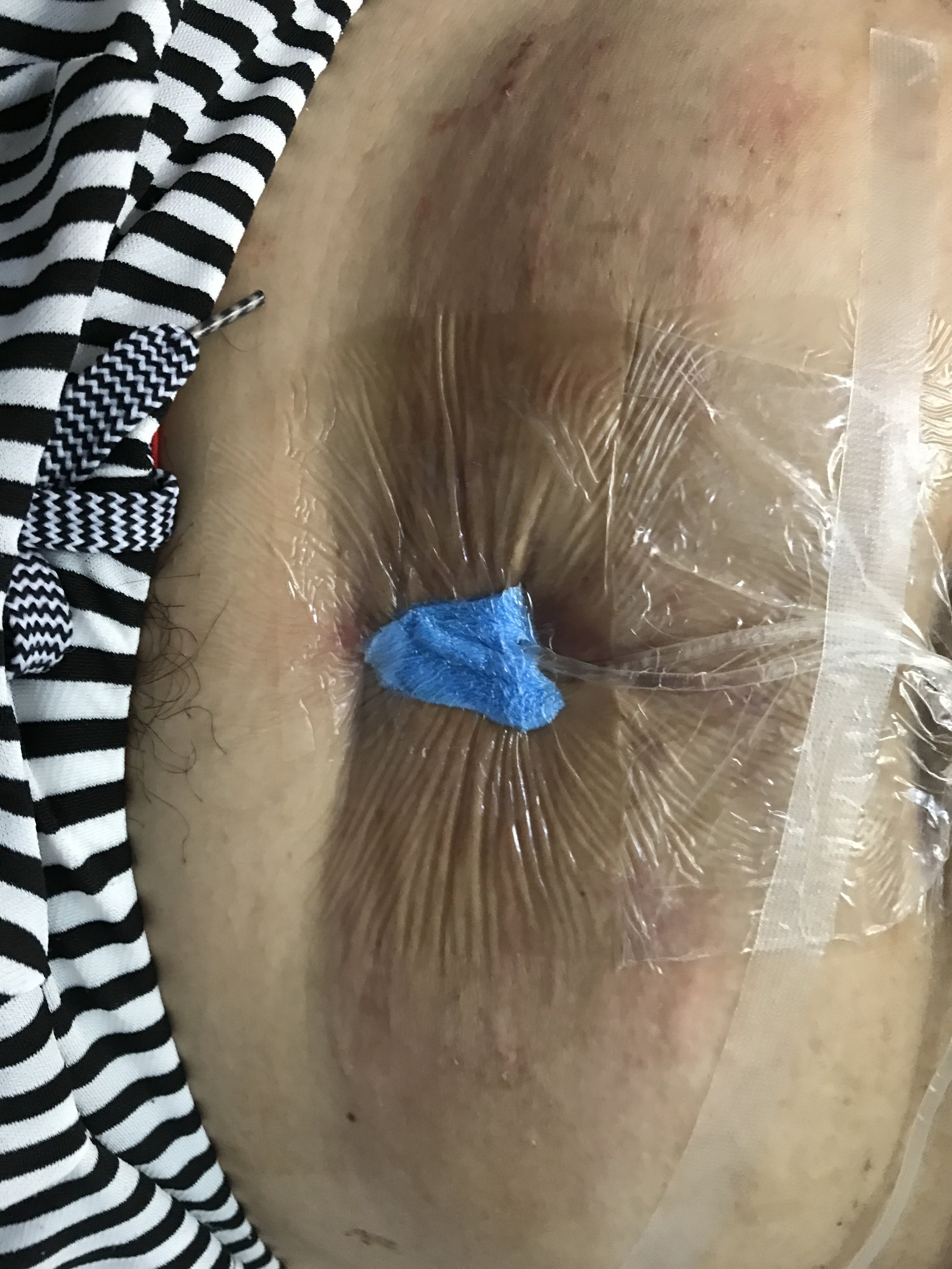 肛瘘手术后的饮食_肛瘘术后饮食禁忌_饮食手术肛瘘后注意事项