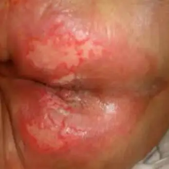 肛门病因失禁症状_肛门失禁病因_肛门病因失禁怎么治疗