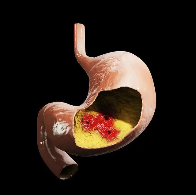 胃溃疡中医治疗方法_胃中医治疗方法溃疡效果好吗_胃中医治疗方法溃疡怎么治疗