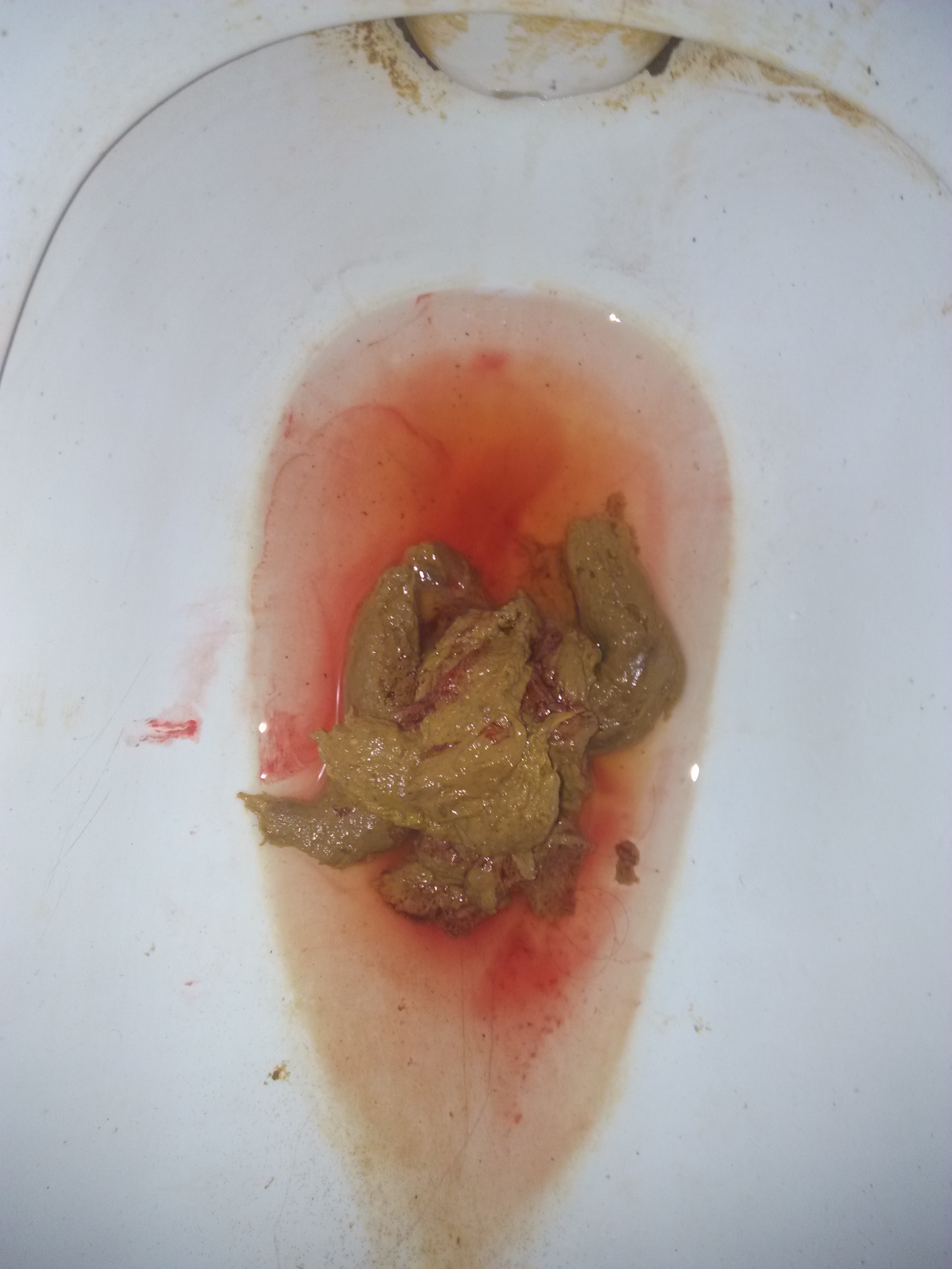 拉大便拉出好多鲜血-突然便血吓坏我，原因究竟为何？赶紧就医求安心