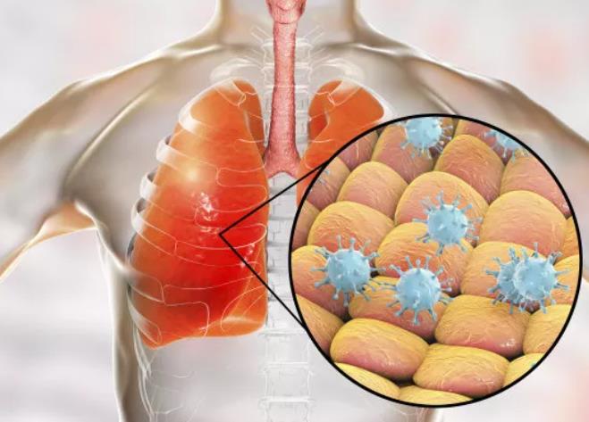 气管炎传染吗-急性气管炎会传染，慢性气管炎不会？快来了解一下