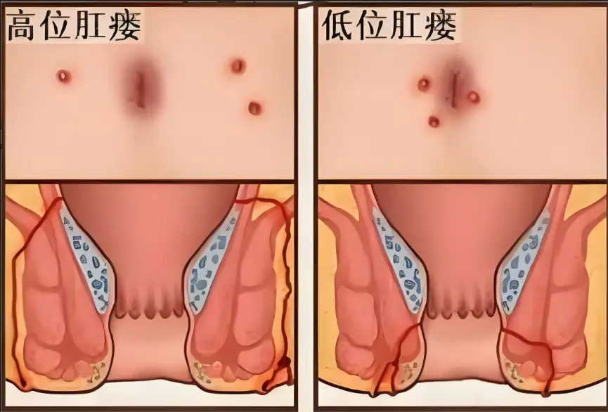 肛瘘手术时长_肛瘘手术时间_手术肛瘘时间多久