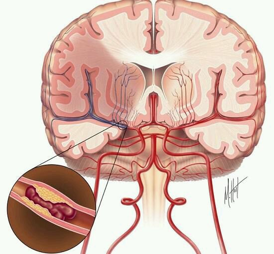 进展性卒中名词解释_进展性卒中治疗指南_进展性卒中概念