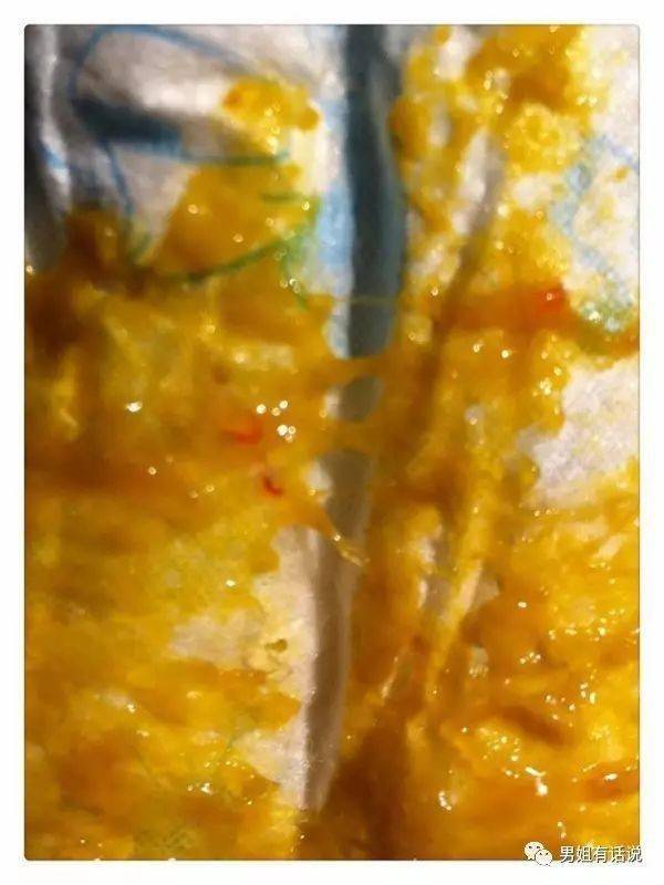 溃疡性结肠炎大便拉出很多鲜血-溃疡性结肠炎的痛苦折磨：大便带血、长期治疗与心理煎熬