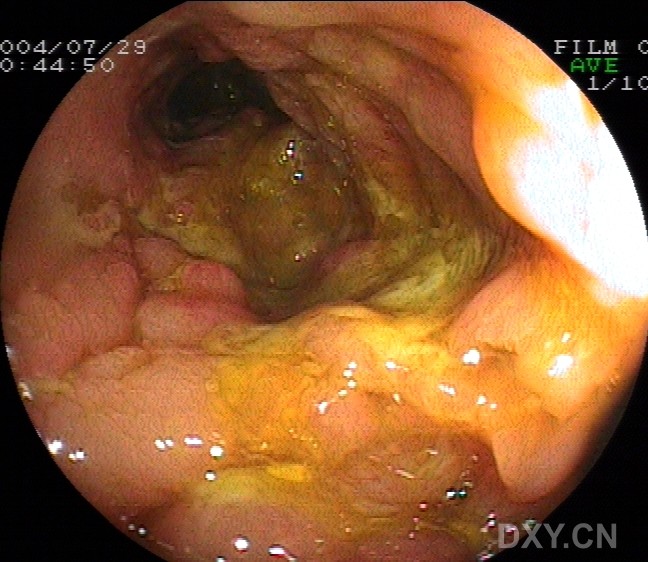 克罗恩护理常规ppt_克罗恩病护理问题和护理诊断_克罗恩护理查房ppt