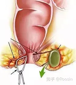 做肛瘘手术多长时间能同房_做肛瘘多久可以同房_肛瘘手术多久能做
