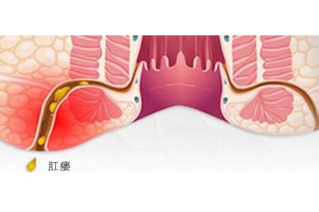 肛瘘手术多久能做_做肛瘘手术多长时间能同房_做肛瘘多久可以同房