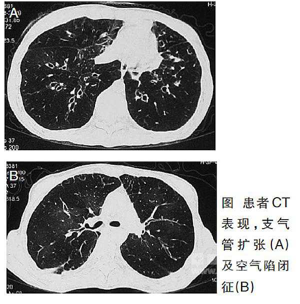 支气管肺炎小儿治疗_儿童支气管肺炎如何治疗_小儿支气管炎肺炎用药