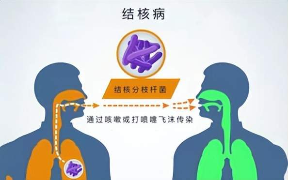 肺结核死人会传染吗_肺结核三型会死人吗_有肺结核的人死后会有传染性吗