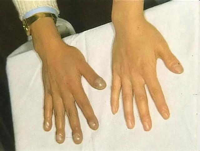 肺结核死人会传染吗_有肺结核的人死后会有传染性吗_肺结核三型会死人吗