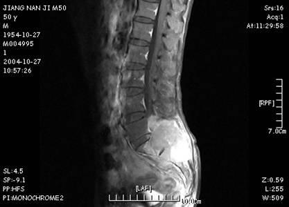肛门失禁有救吗_肛门失禁怎么护理_肛门失禁的可以治疗吗