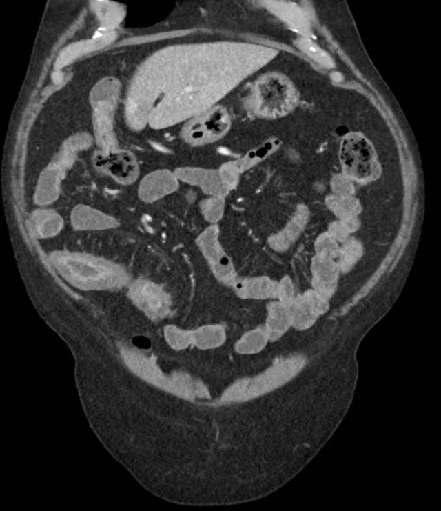 罗克恩是什么病_克罗恩病能治好吗_罗克恩病能治好吗