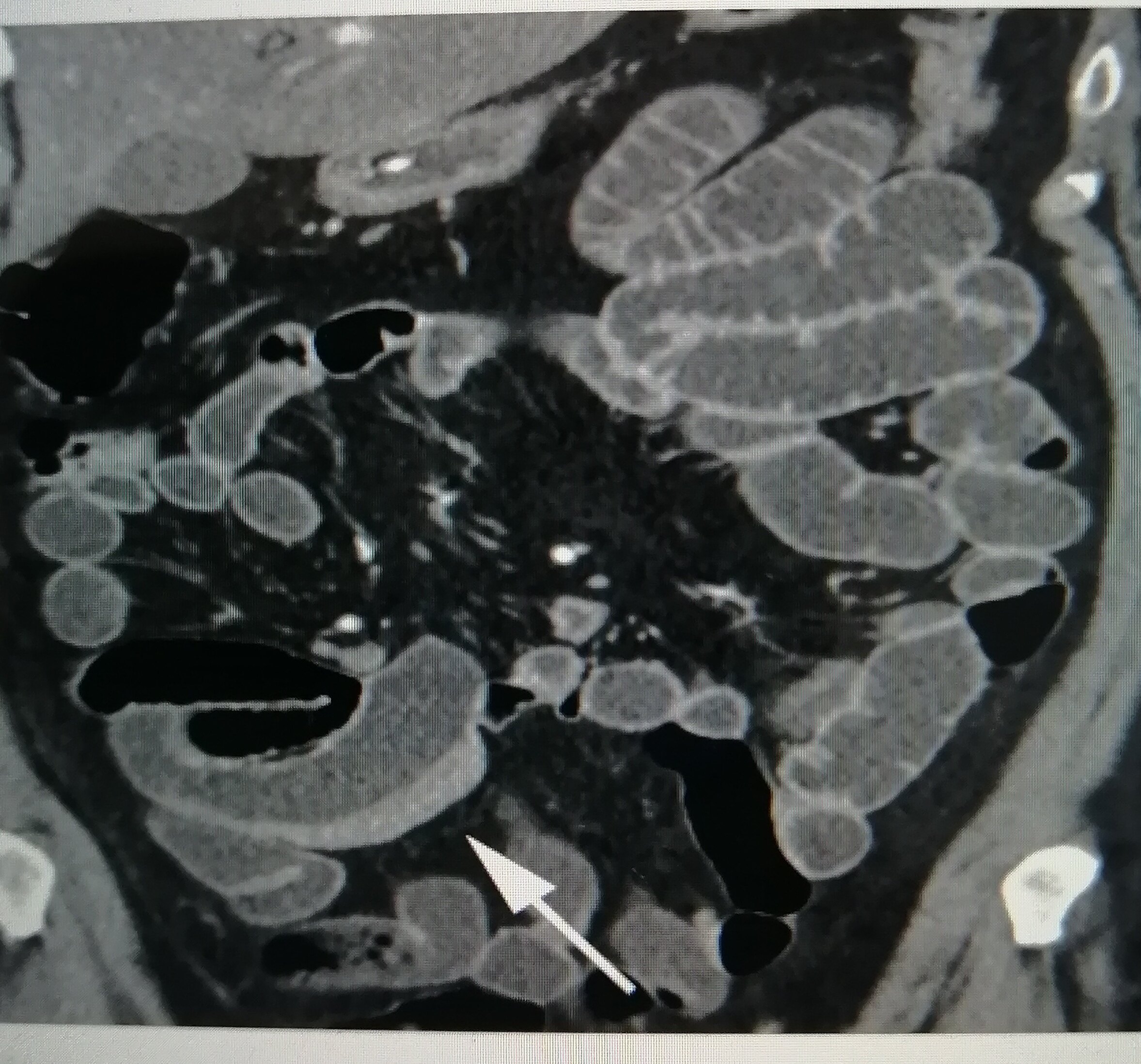 克罗恩诊断与鉴别诊断_判断克罗恩病的依据是什么_克罗恩病的鉴别诊断