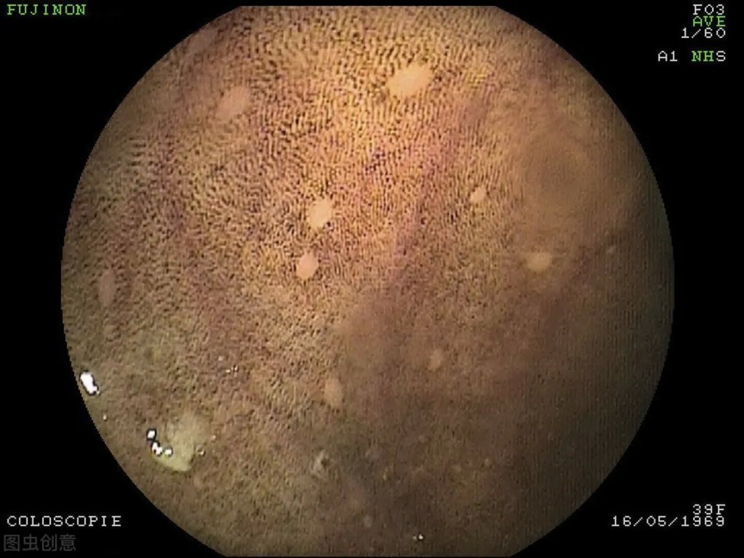 克罗恩病肠镜图片-肠镜下的克罗恩病：真实影像揭示身边的无声病魔