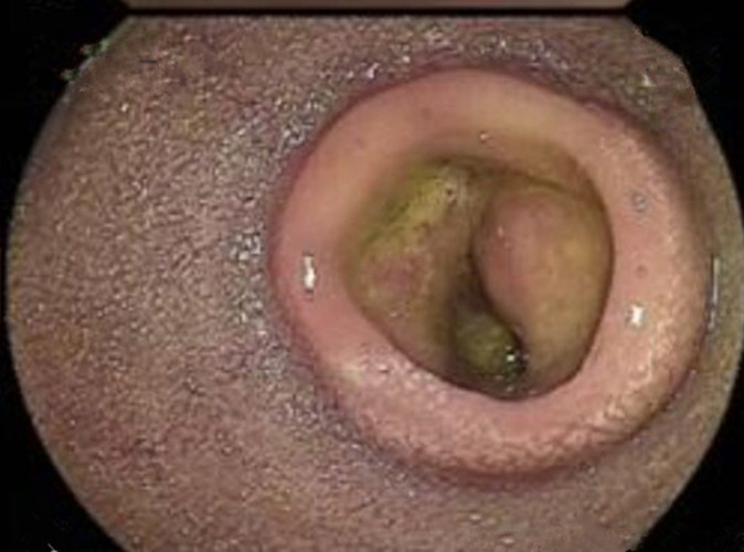 罗恩病的症状_克罗恩病肠镜图片_罗恩病是什么