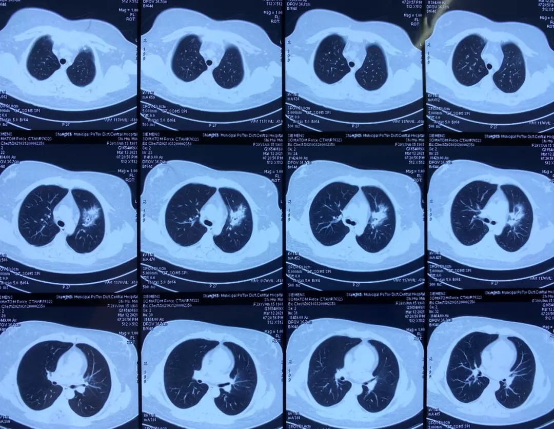 肺癌咳嗽白痰，痛苦折磨无人懂，患者生活巨变令人心碎