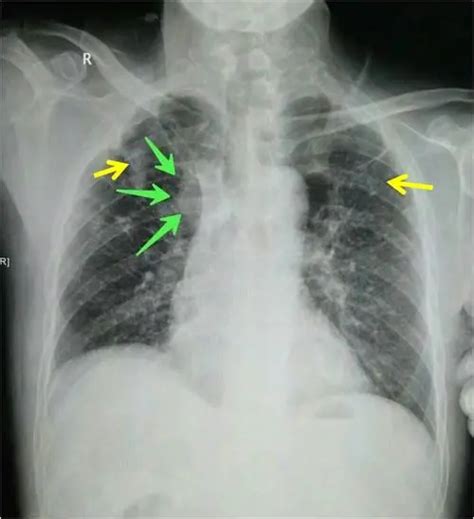 三型肺结核会传染吗_肺传染结核型会复发吗_肺结核传染可能性