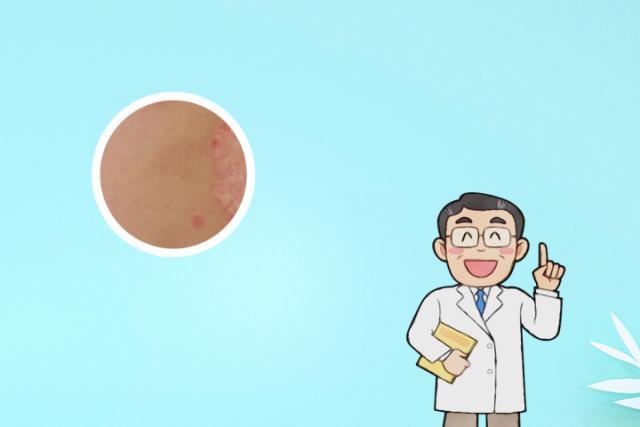 脸部掉皮屑是什么原因-脸上掉皮屑？可能是这些原因！快来看看你中了几招