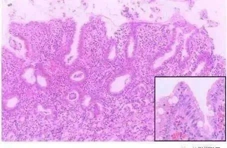 克罗恩病关节炎看什科_克罗恩关节痛_克罗恩导致的关节炎的症状