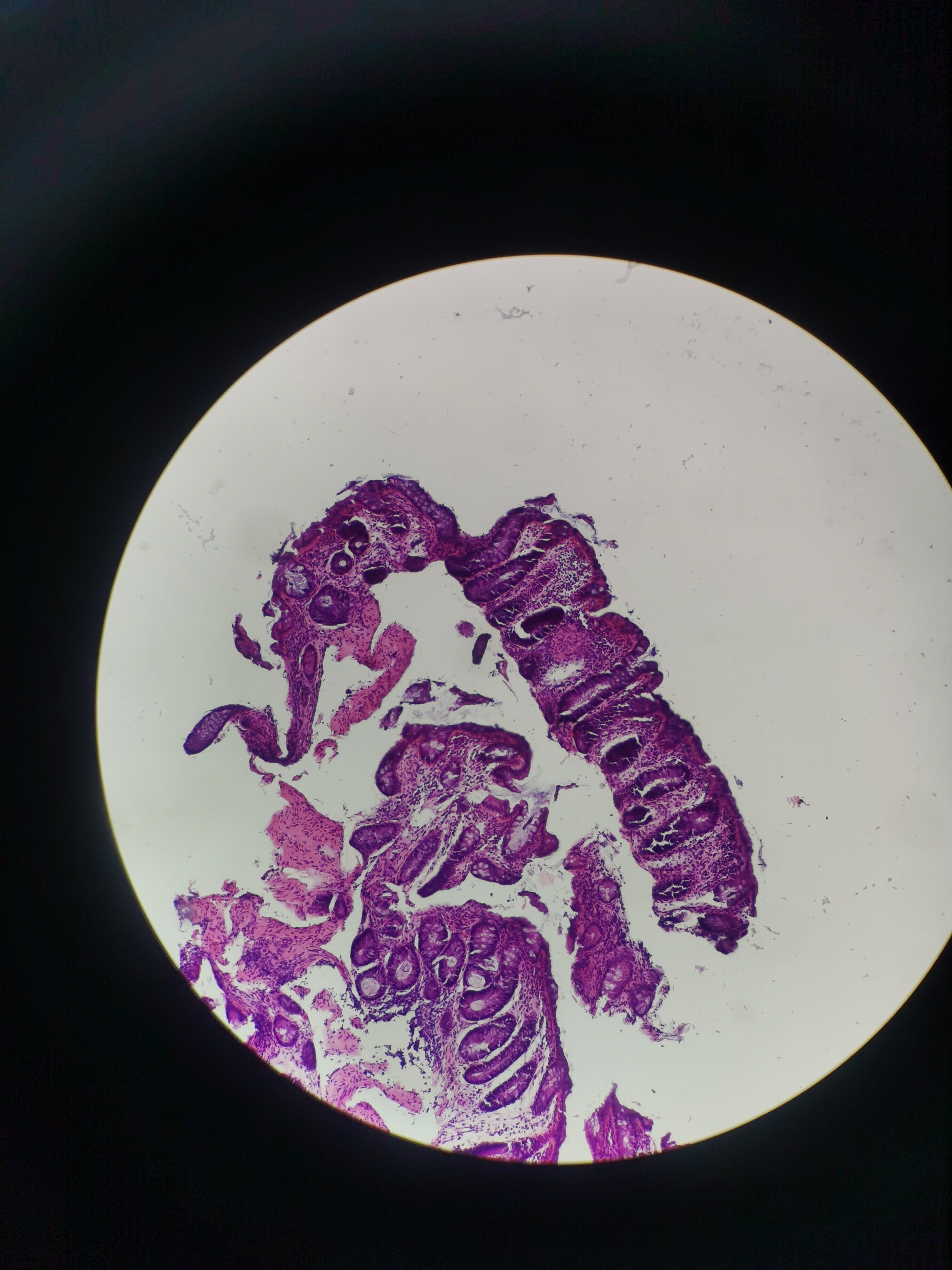 克罗恩病关节炎看什科_克罗恩关节痛_克罗恩导致的关节炎的症状