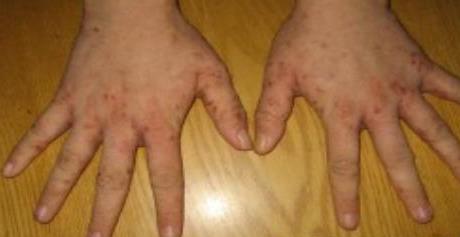 疥疮为什么久治不愈-如何战胜顽固的疥疮？这些方法你试过吗？