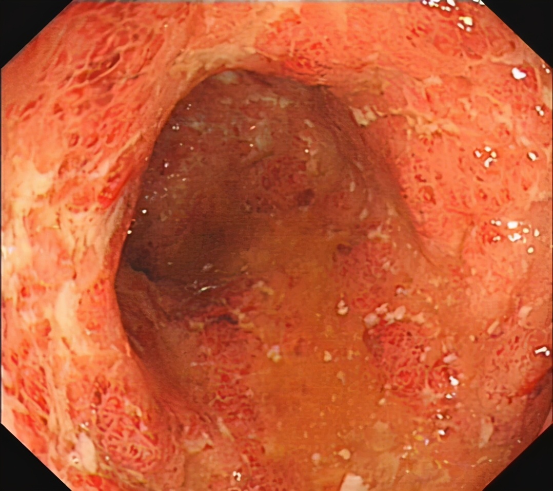 克罗恩能治好吗_罗克恩病能治好吗_能治罗恩克好的中成药