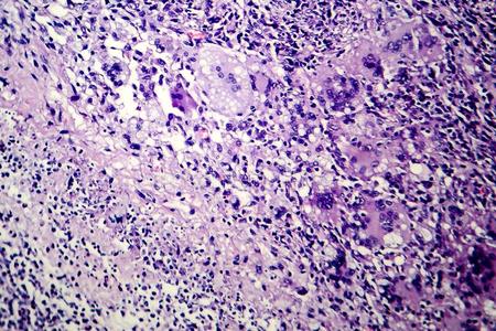 肺结核严重会死吗_肺结核严重会变肺癌吗_肺结核严重了会怎样