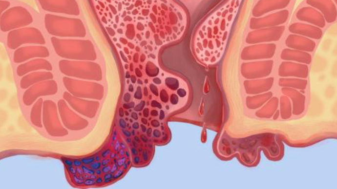 拉鲜血大便好多出血_拉大便拉出鲜血_拉大便拉出好多鲜血