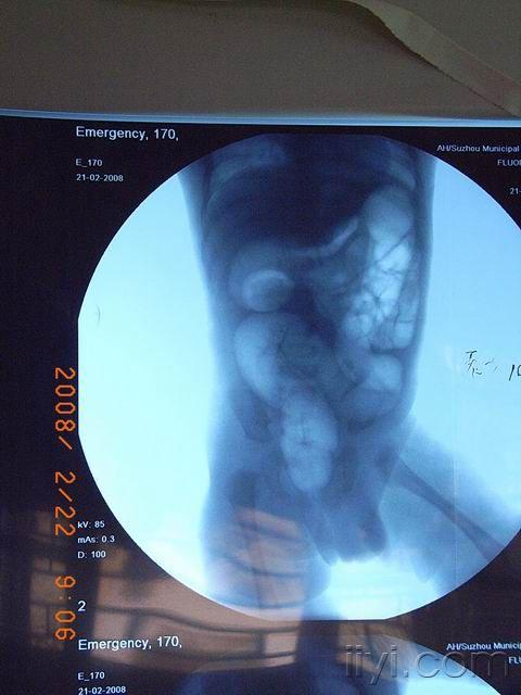 肠套叠ct图_肠套叠ct描述模板_肠套叠的典型ct征象