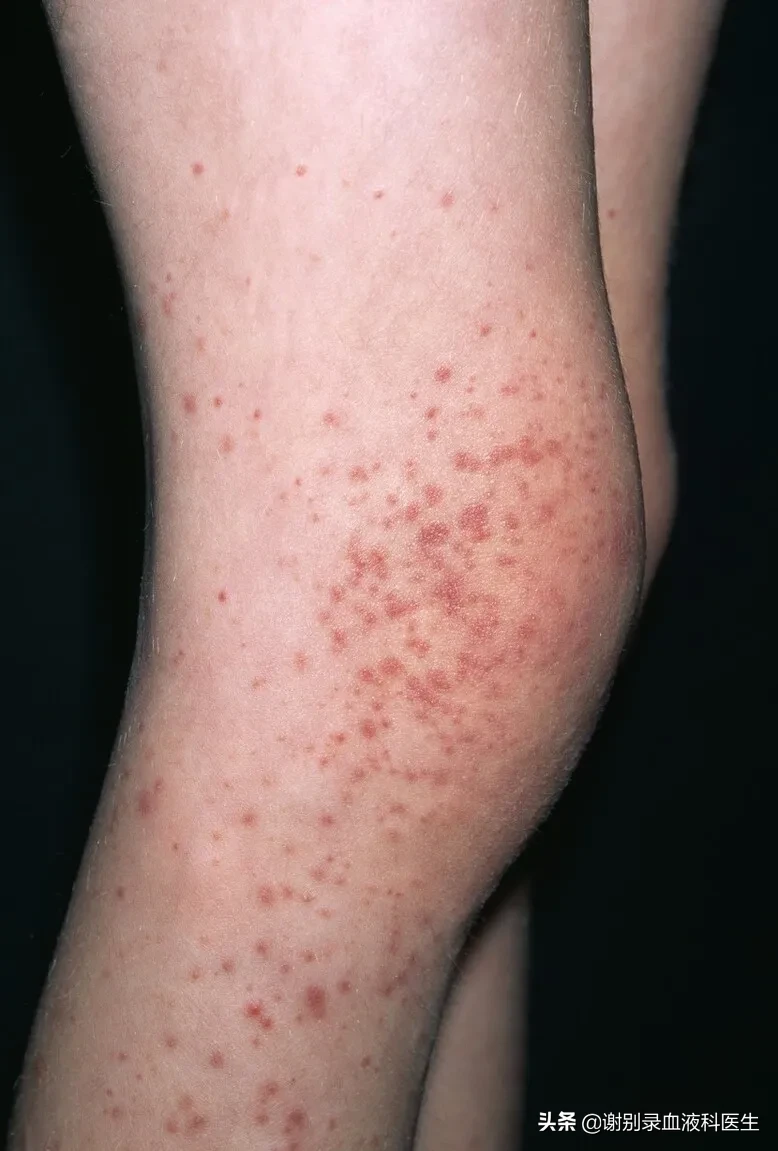 血液疾病的常见症状_血液疾病症状_血液症状疾病有哪些