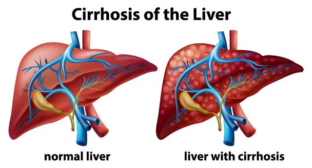 肺癌铁蛋白高是怎么回事_肺癌铁蛋白_铁蛋白肺癌