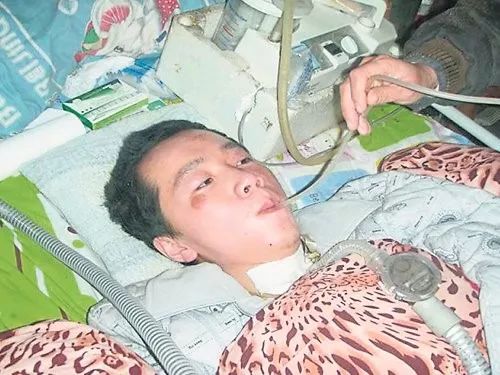 脊髓性肌萎缩症是_脊髓性肌萎缩症_脊髓性肌萎缩症的临床实践指南