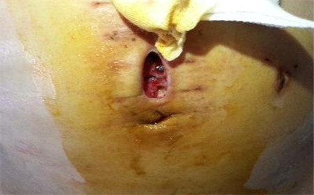 克罗恩类克_克罗恩打类克到底好不好_类克克罗恩病